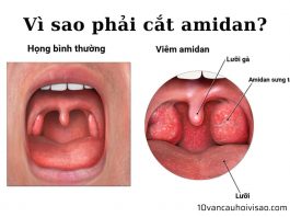 vi-sao-phai-cat-amidan