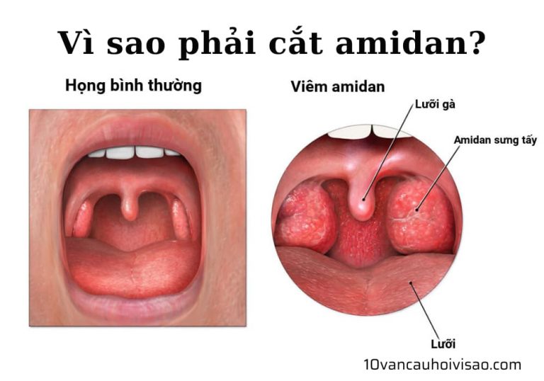 vi-sao-phai-cat-amidan