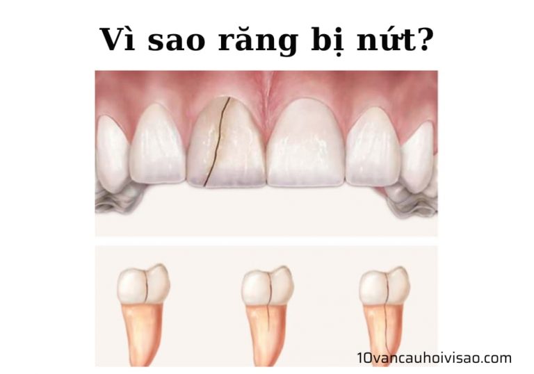 vi-sao-rang-bi-nut