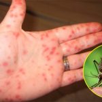 Vì sao người mắc sốt xuất huyết có nguy cơ tử vong?