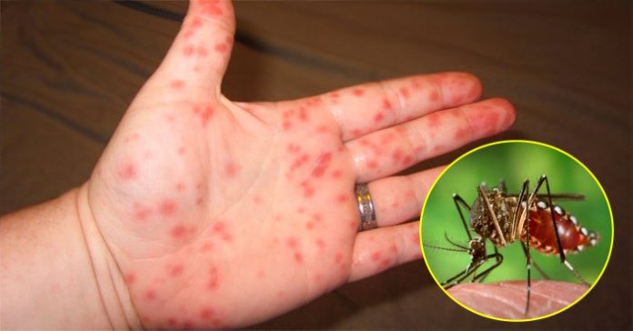 Vì sao người mắc sốt xuất huyết có nguy cơ tử vong?