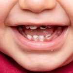 Vì sao răng sữa dễ bị sâu răng?