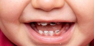 Vì sao răng sữa dễ bị sâu răng?