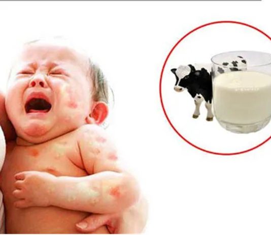 Vì sao trẻ bị dị ứng đạm sữa bò?